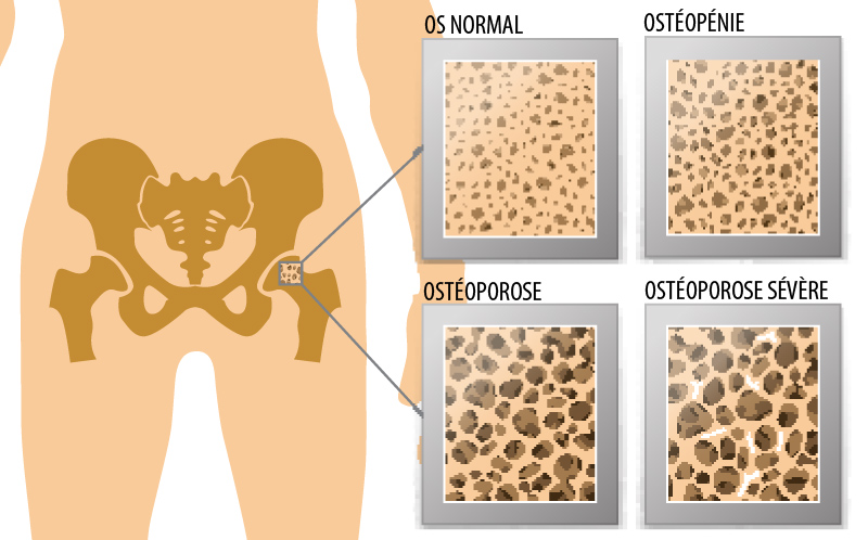 stades de l'ostéoporose