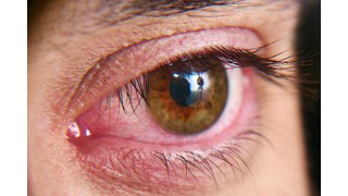 le Syndrome de Gougerot-Sjögren Nutrinia