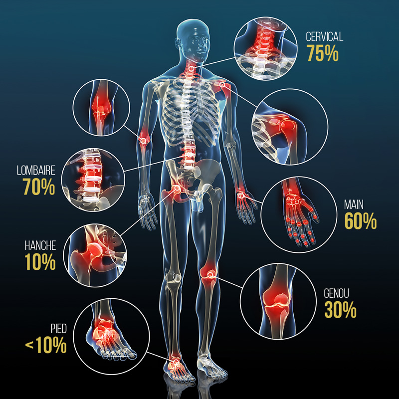 répartition clinique des principales formes d'arthrose