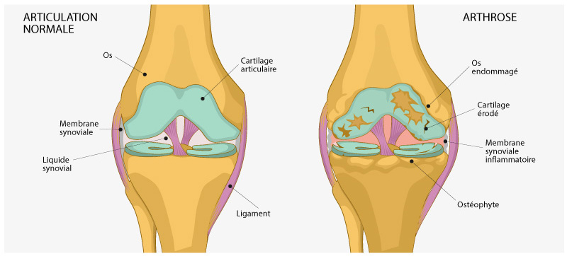 effet de l’arthrose sur les articulations